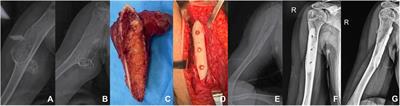 Application of allograft and absorbable screws in the reconstruction of a massive bone defect following resection of giant osteochondroma: A retrospective study